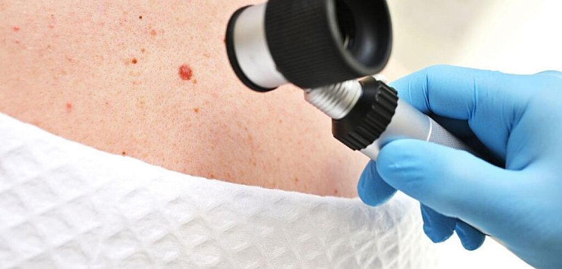 Zmiana skórna – kiedy wymaga pogłębionej diagnostyki?